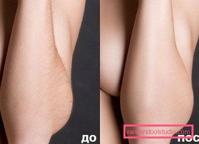 жіночі передпліччя до і після кошти жіночі передпліччя до і після кошти