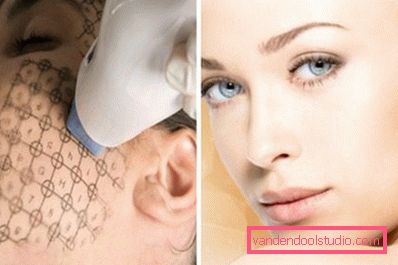 хід процедури thermage хід процедури thermage