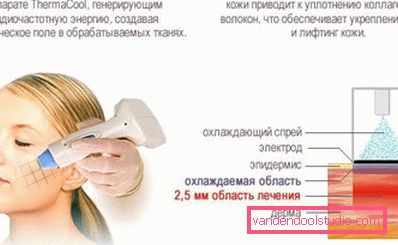 апарат thermacool апарат thermacool